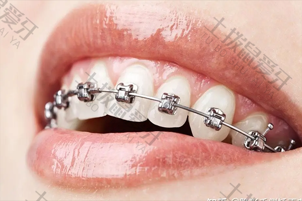 牙齿早期矫正干预方法