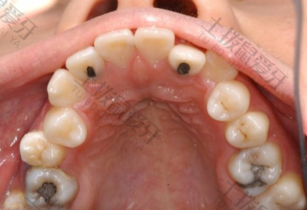 牙齿深覆合成人能矫正吗
