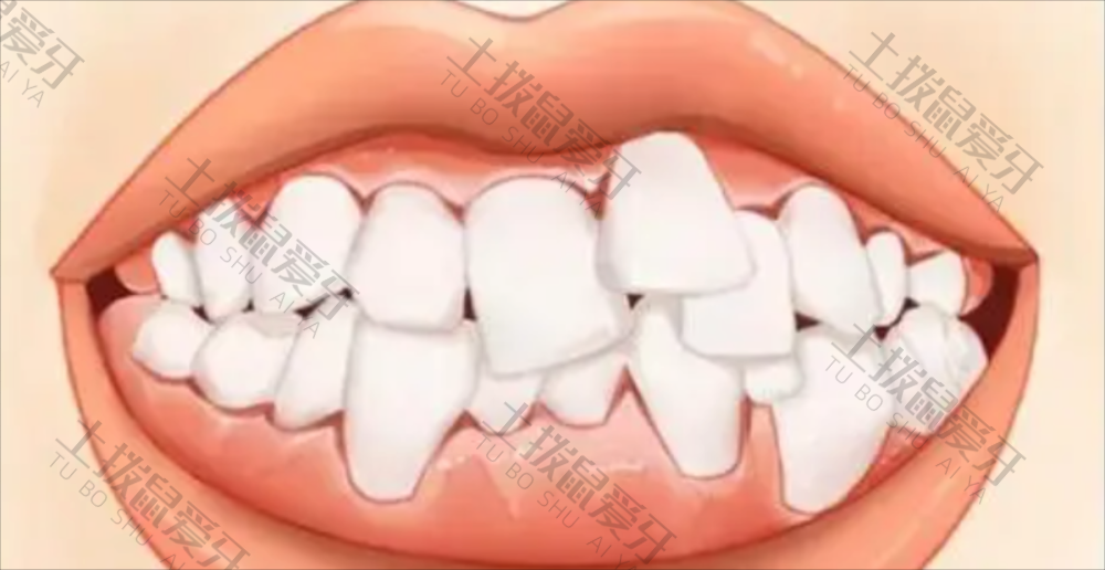牙齿拥挤不拔牙可以矫正吗