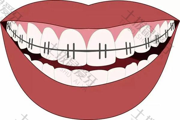 矫正牙齿拥挤效果怎么样