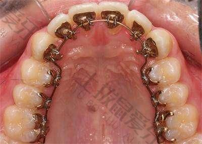 牙齿稀疏矫正原理是什么
