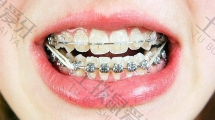 牙齿稀疏矫正需要多长时间