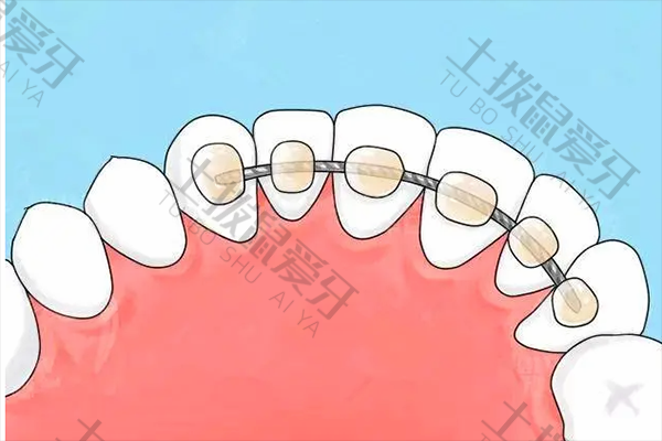 牙齿稀疏矫正原理是什么