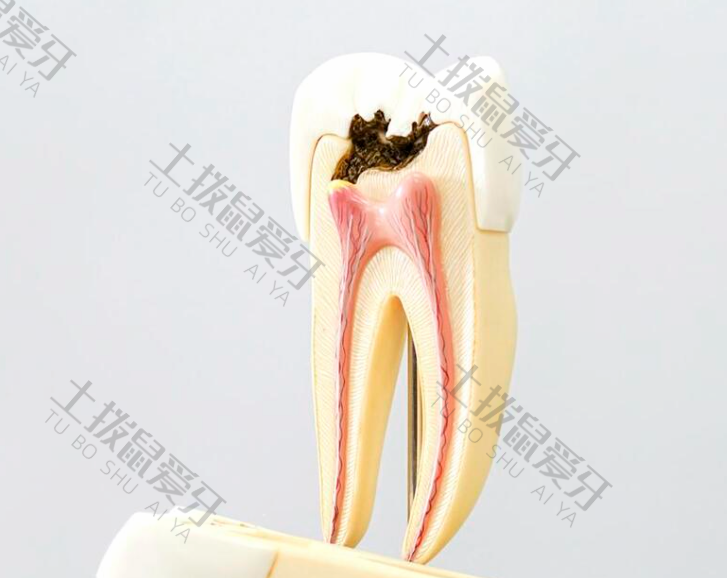 根管治疗牙齿的好处和坏处