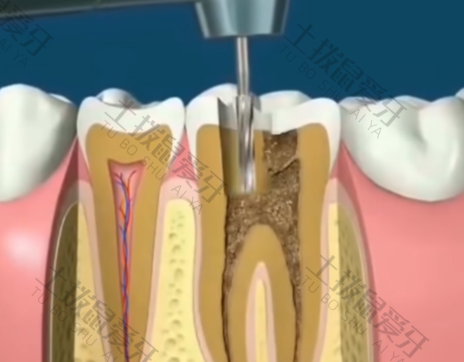 牙髓炎根管治疗多少钱