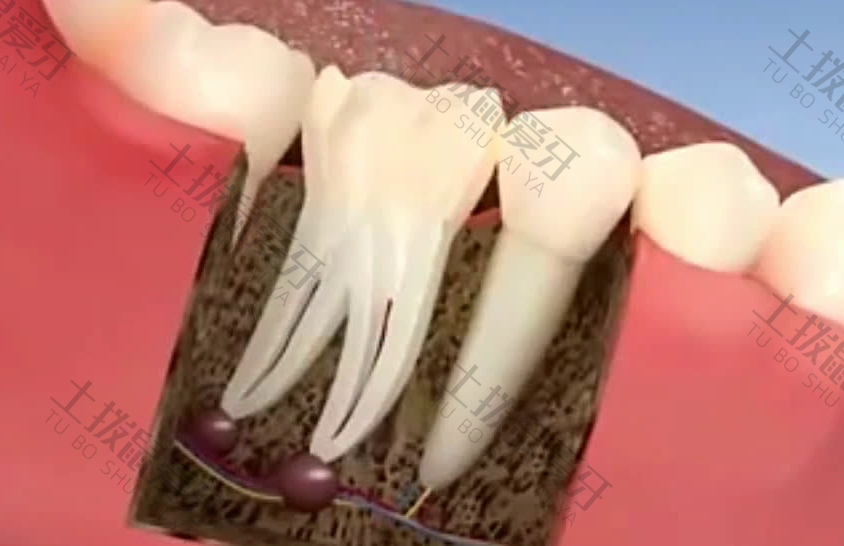 牙齿根管治疗是怎么回事