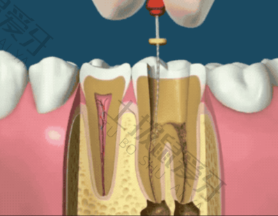 牙齿根管治疗的利弊
