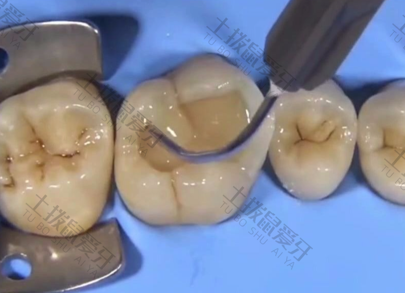 牙齿根管治疗步骤过程