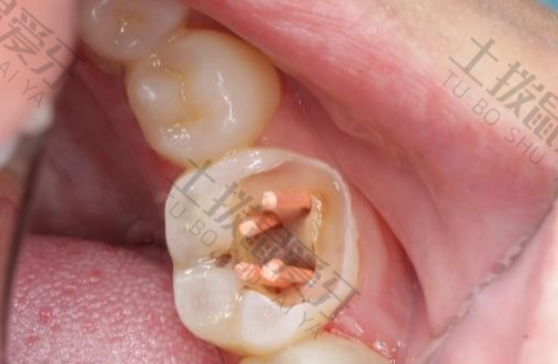 牙齿根管治疗步骤过程