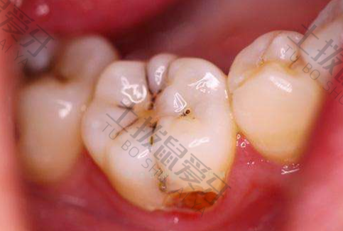 儿童补牙的禁忌有哪些