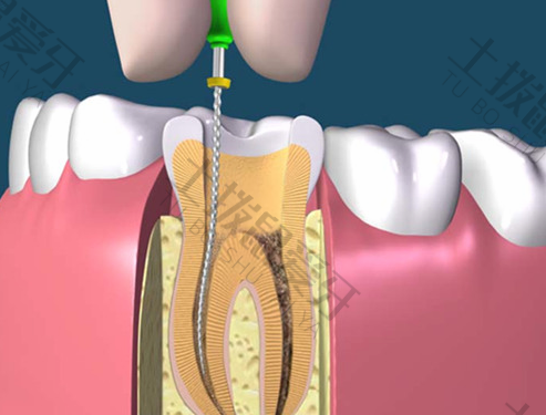 补牙过程中如何避免疼痛