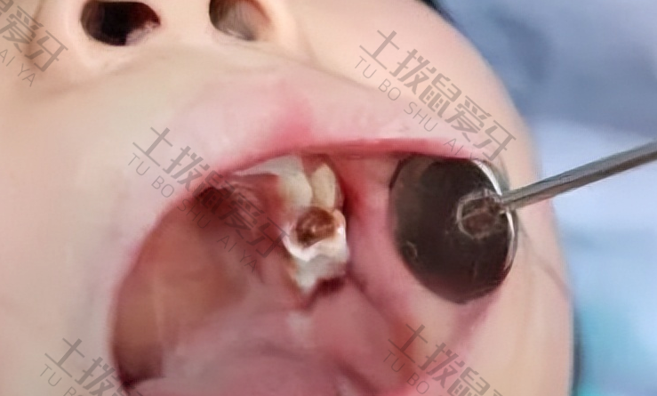 补的牙洞可以维持多久