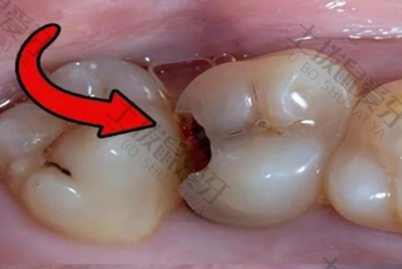 补的牙洞可以维持多久