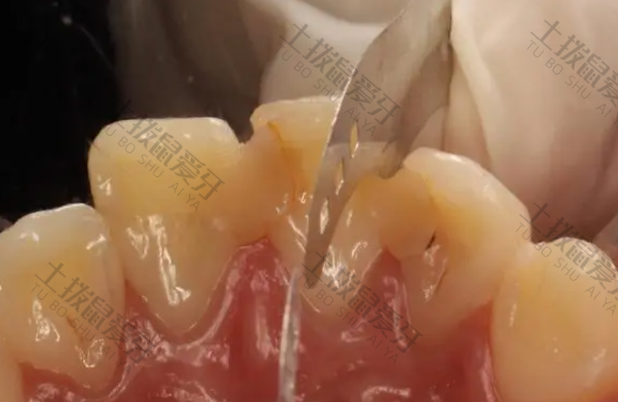龋齿补牙操作流程