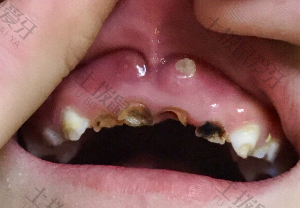 龋齿补牙操作流程