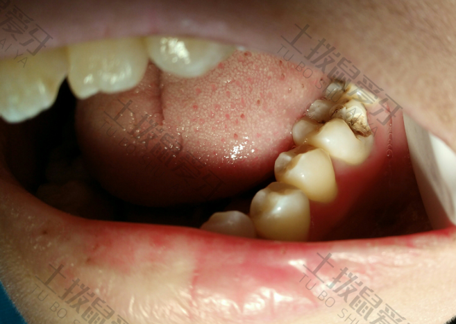 拔牙后疼痛的解决办法是什么