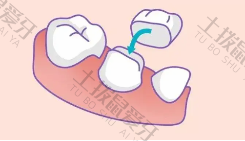 烤瓷牙崩瓷的修复方法是什么