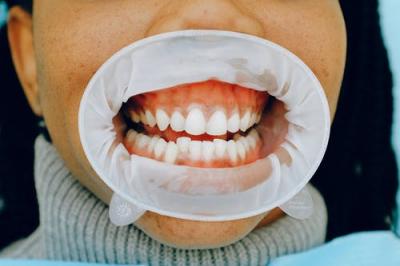牙齿常见的问题有哪些，如何预防
