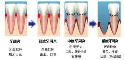 牙周炎会影响种植牙吗 什么是植体周围炎
