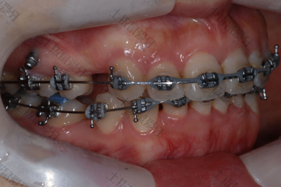 牙齿矫正收牙缝原理 牙齿矫正收牙缝要多久