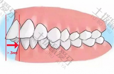 牙齿深覆盖矫正过程图 牙齿深覆盖怎么矫正