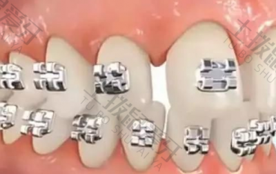 矫正牙齿牙缝收缩原理 牙齿矫正能收缩牙缝吗