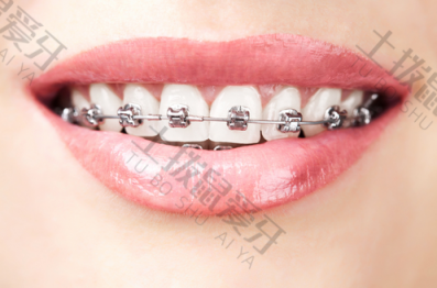 矫正牙齿金属还是陶瓷的牙套好 牙齿矫正牙套价格表