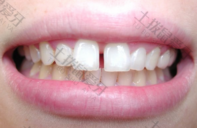 矫正牙齿门牙有缝隙正常吗 矫正收缝需要多久时间