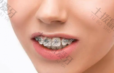 戴金属自锁牙套矫正牙齿的过程 戴金属自锁牙套注意事项 