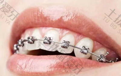 金属自锁牙套矫正过程中会拆吗 金属自锁牙套会自己移动钢丝吗