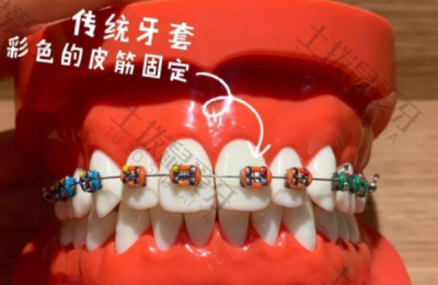 牙齿矫正器有哪几种 牙齿矫正器各有什么优缺点