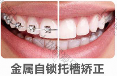 金属自锁牙套矫正全过程多少钱 金属自锁牙套矫正流程 