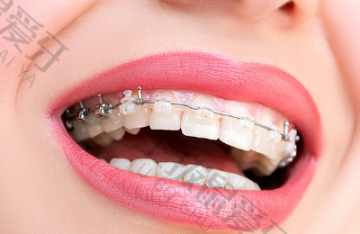 陶瓷自锁牙齿矫正过程可以改善下颌后缩吗 陶瓷矫正过程中牙齿松动是正常的吗 