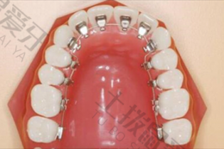 舌侧粘接托槽矫正方法的优势 牙齿内侧粘托槽磨舌头吗