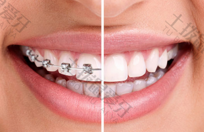 金属矫正牙齿的作用原理 金属牙齿能做磁共振吗 