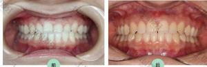 28岁错颌畸形矫正案例