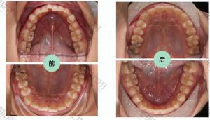 地包天牙齿矫正案例