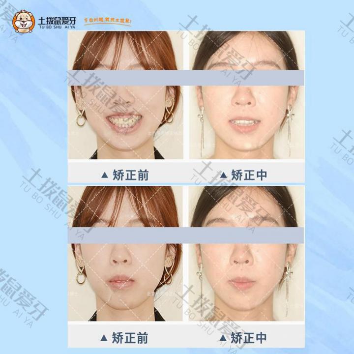 骨性畸形隐适美隐形矫正案例