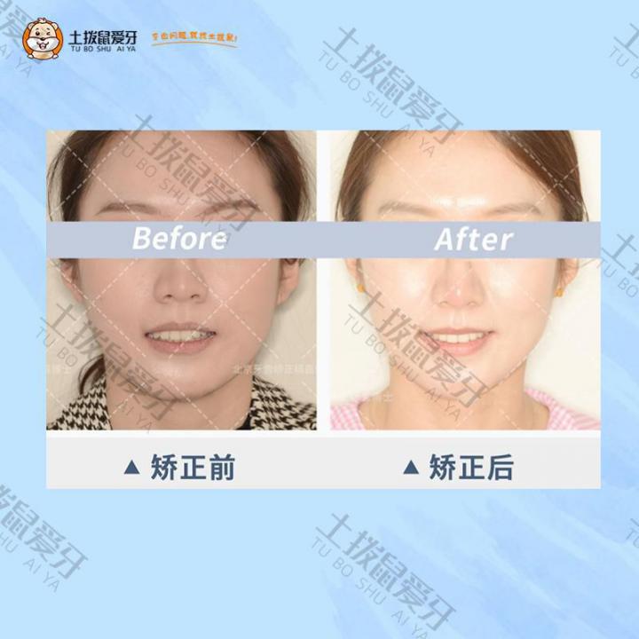 牙列不齐、咬合深矫正案例