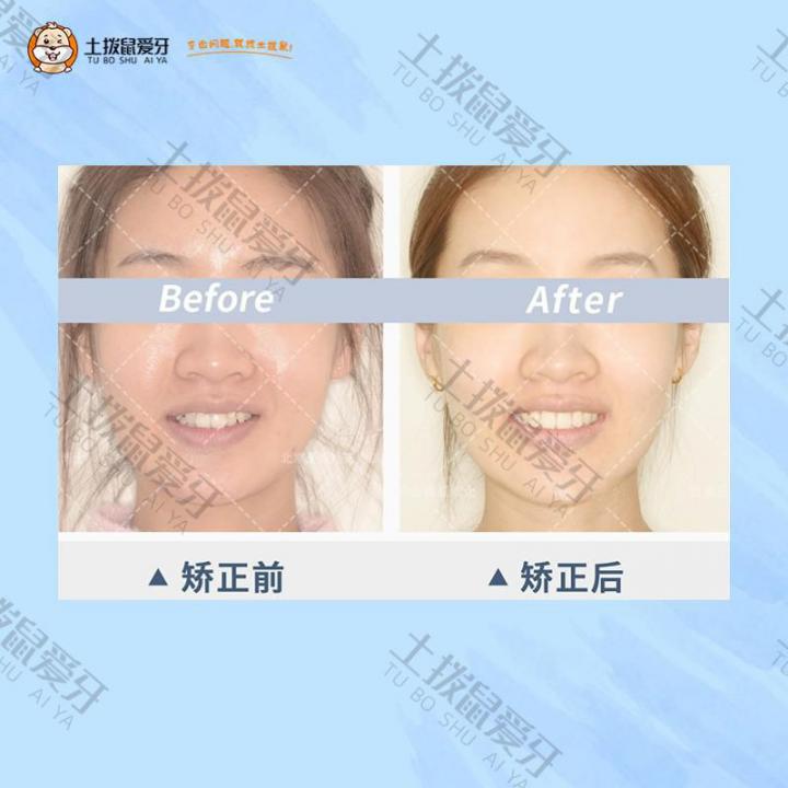 牙列拥挤不齐矫正案例