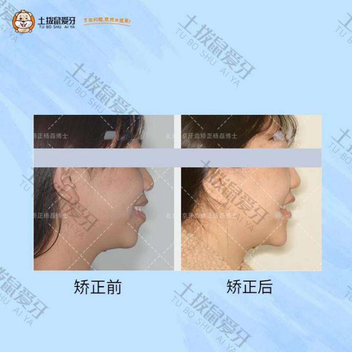 牙齿前突、下巴后缩牙齿矫正案例