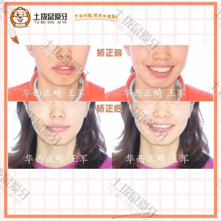 成年女性上牙前突矫正案例