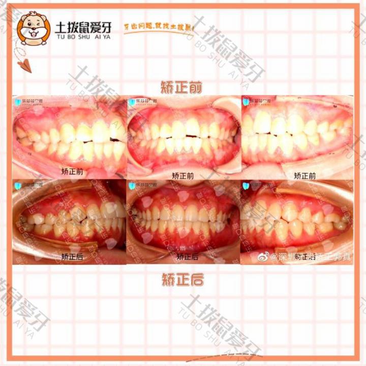 中度拥挤深覆合矫正案例