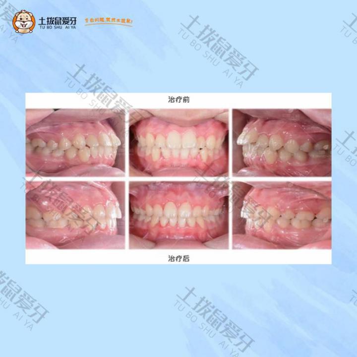 双颌前突不齐矫正案例