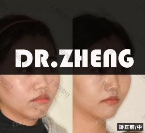 成年女性嘴凸隐形矫正案例