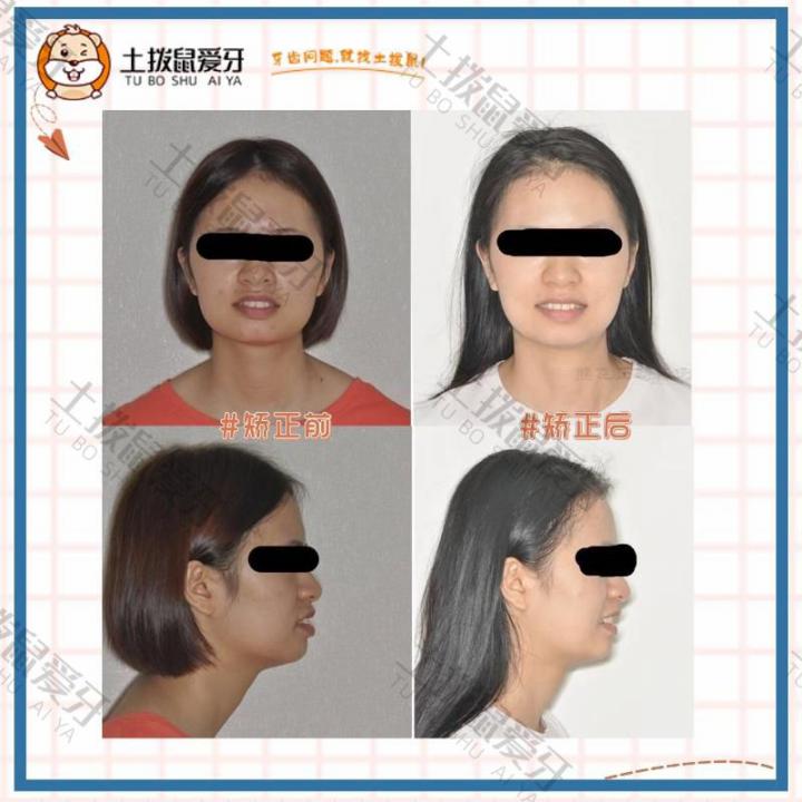 成年女性牙齿前突 龅牙矫正案例