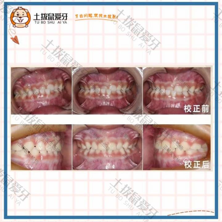 儿童乳牙期反颌、偏颌早期矫治案例