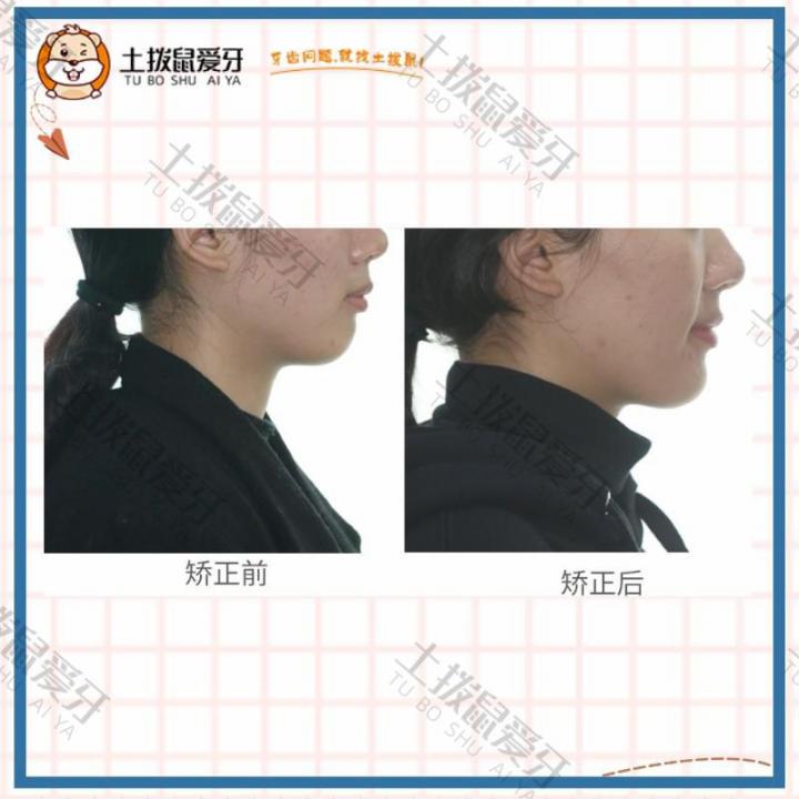 成年女性骨性上颌前突，下巴后缩矫正案例
