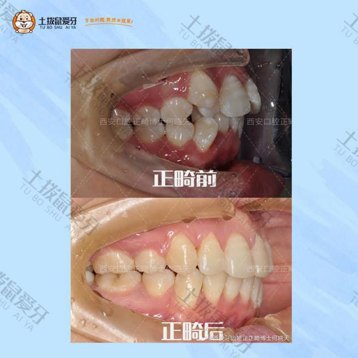 牙齿拥挤不齐固定矫正案例