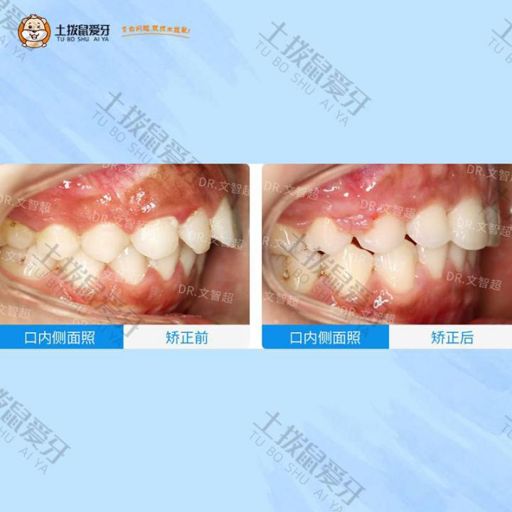 牙齿深覆盖金属矫正案例